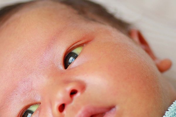 Newborn Jaundice: Normal or Worrying? A Neonatologist's Guide for Parents